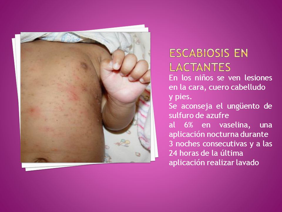 Si es posible es el caviar rojo a la psoriasis
